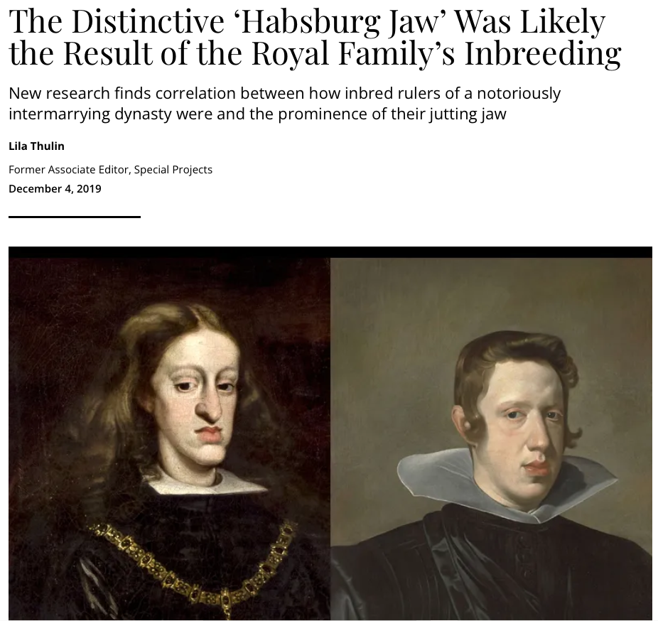 Portrait of Charles II of Spain showing Habsburg jaw deformity from royal inbreeding